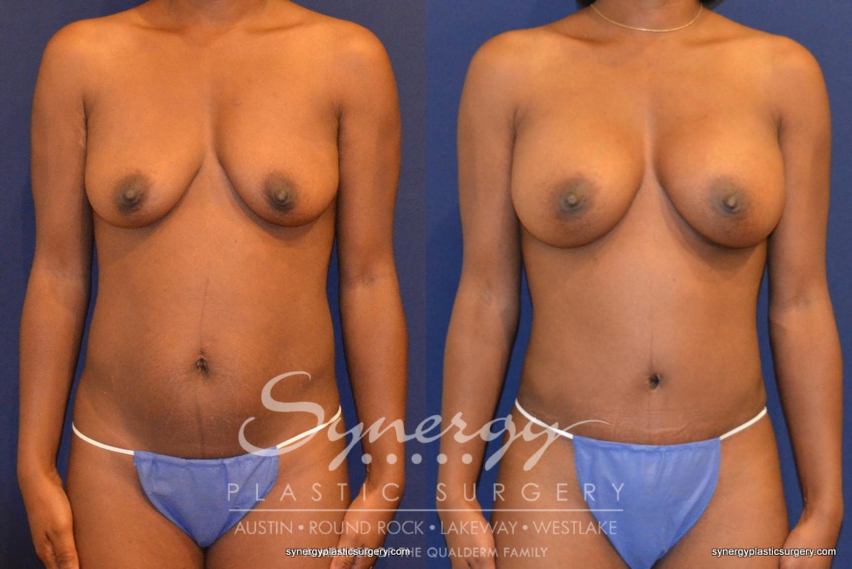 Before & After Mommy Makeover Case 344 View #1 View in Austin, TX