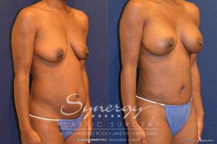 Before & After Mommy Makeover Case 344 View #2 View in Austin, TX