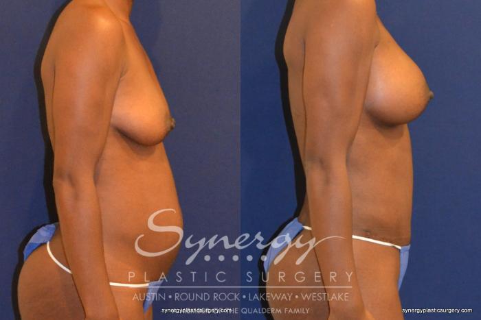 Before & After Mommy Makeover Case 344 View #3 View in Austin, TX