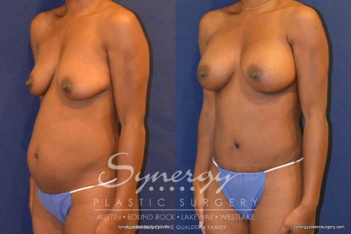 Before & After Mommy Makeover Case 344 View #4 View in Austin, TX