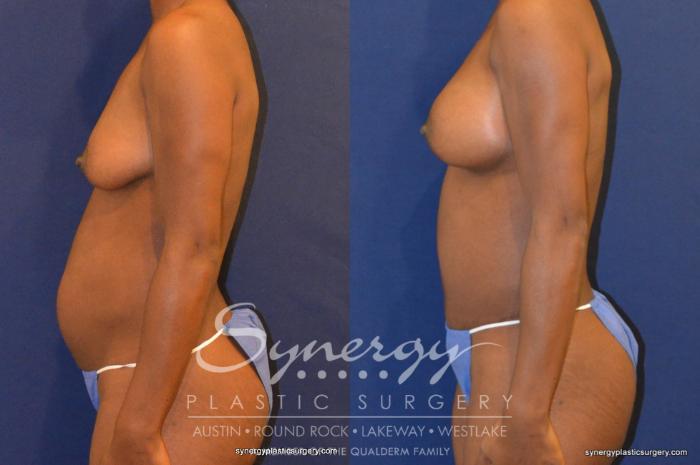 Before & After Mommy Makeover Case 344 View #5 View in Austin, TX