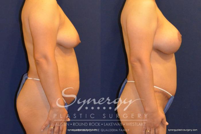 Before & After Mommy Makeover Case 353 View #1 View in Austin, TX