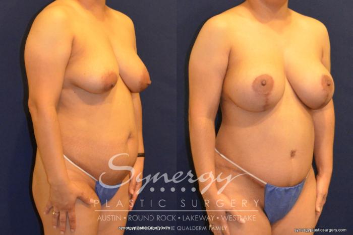 Before & After Mommy Makeover Case 353 View #2 View in Austin, TX