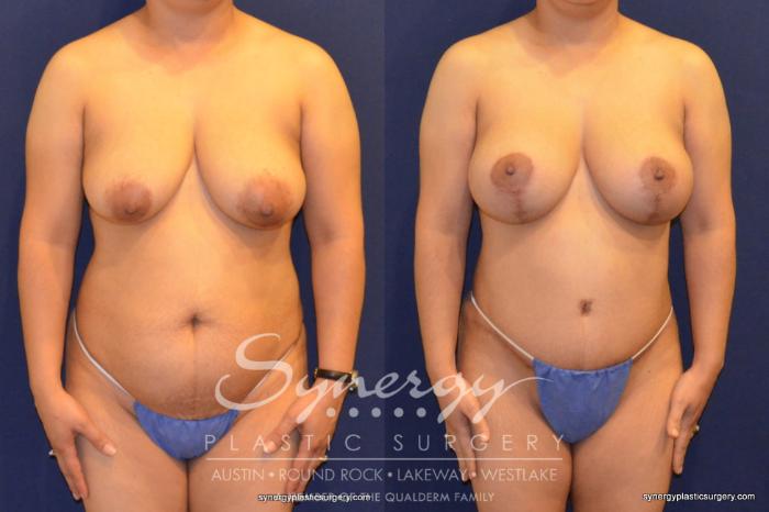 Before & After Mommy Makeover Case 353 View #3 View in Austin, TX