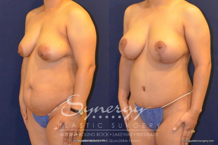 Before & After Mommy Makeover Case 353 View #4 View in Austin, TX