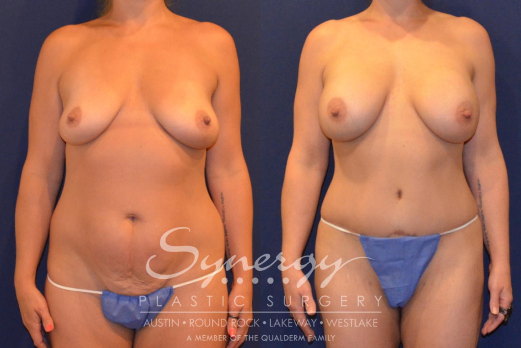 Before & After  Case 362 View #1 View in Austin, TX