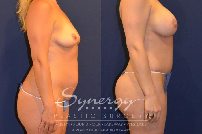 Before & After  Case 362 View #3 View in Austin, TX