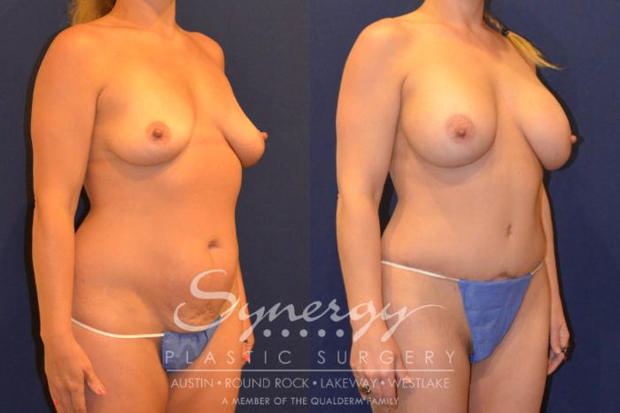 Before & After  Case 362 View #4 View in Austin, TX