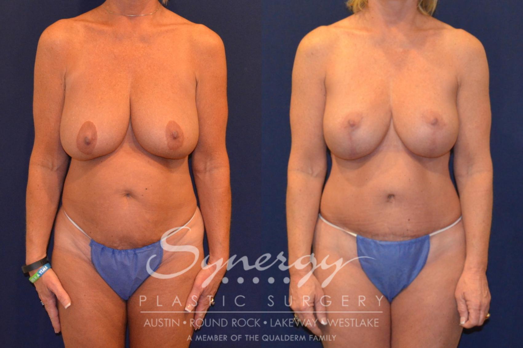 Before & After Mommy Makeover Case 380 View #1 View in Austin, TX