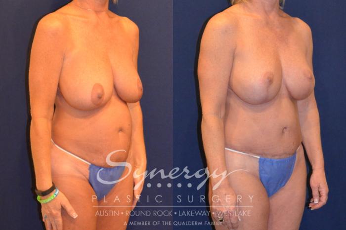 Before & After Mommy Makeover Case 380 View #2 View in Austin, TX