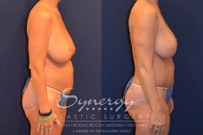 Before & After Mommy Makeover Case 380 View #3 View in Austin, TX