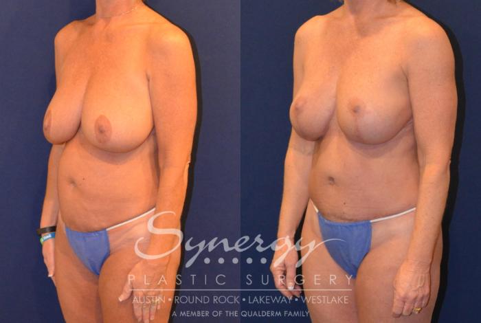 Before & After Mommy Makeover Case 380 View #4 View in Austin, TX