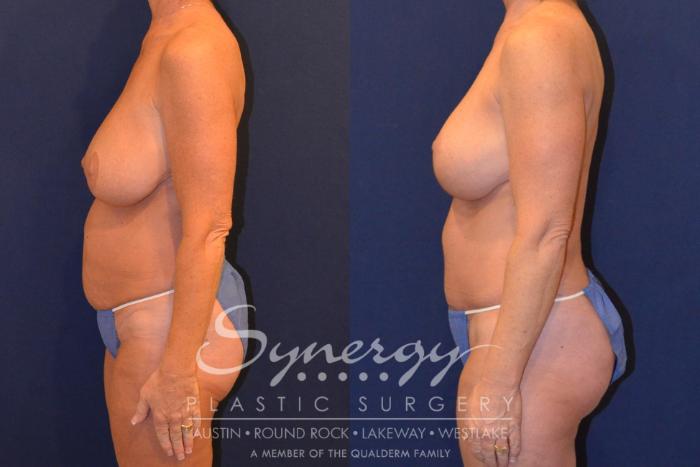 Before & After Mommy Makeover Case 380 View #5 View in Austin, TX