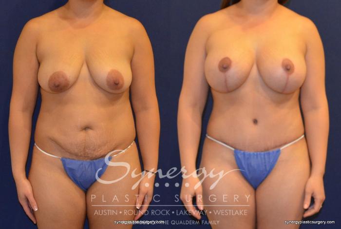 Before & After Mommy Makeover Case 393 View #1 View in Austin, TX