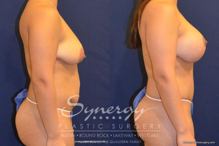 Before & After Mommy Makeover Case 393 View #2 View in Austin, TX