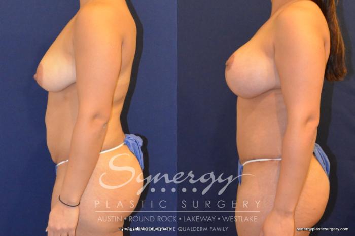 Before & After Mommy Makeover Case 393 View #4 View in Austin, TX