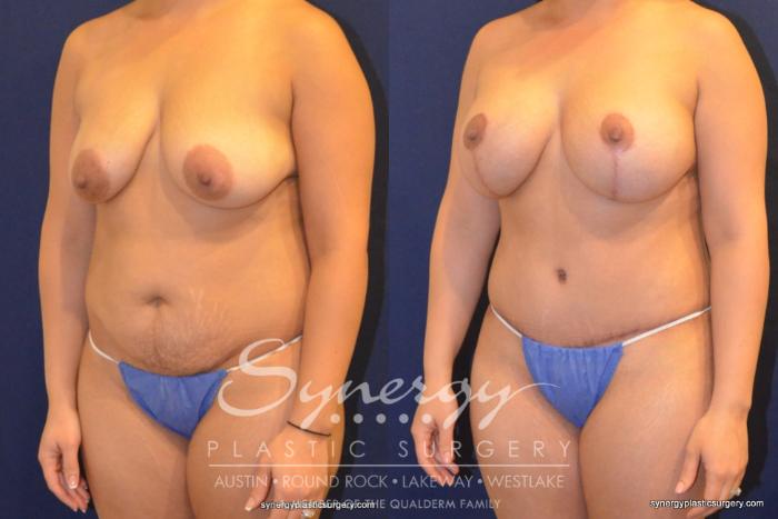 Before & After Mommy Makeover Case 393 View #5 View in Austin, TX