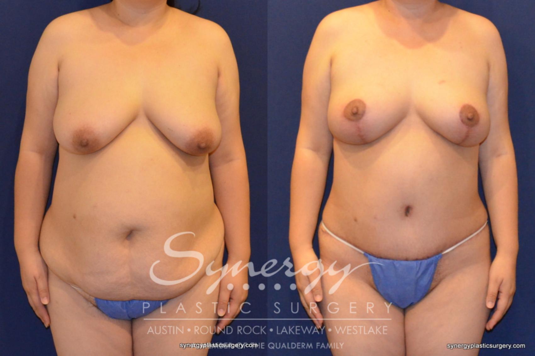 Before & After Mommy Makeover Case 395 View #1 View in Austin, TX