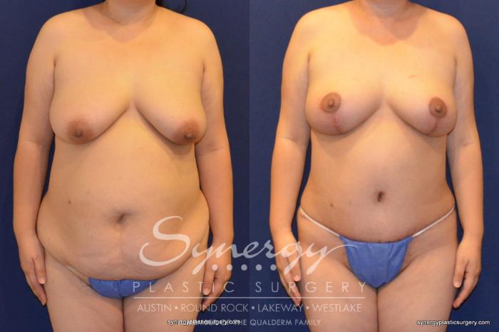 Before & After Mommy Makeover Case 395 View #1 View in Austin, TX