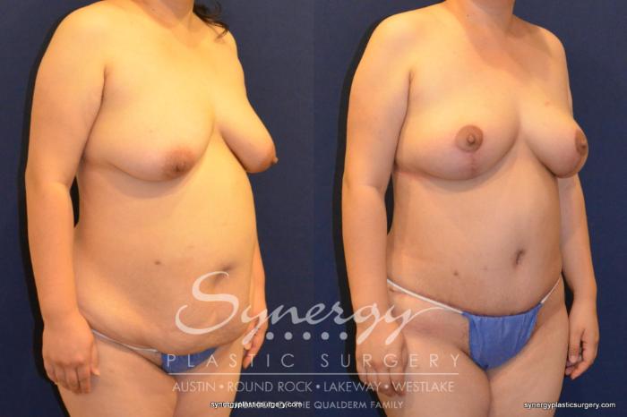 Before & After Mommy Makeover Case 395 View #3 View in Austin, TX