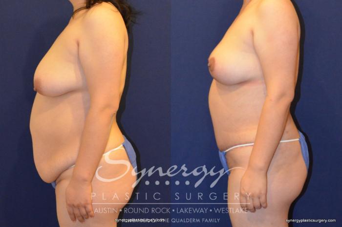Before & After Mommy Makeover Case 395 View #4 View in Austin, TX