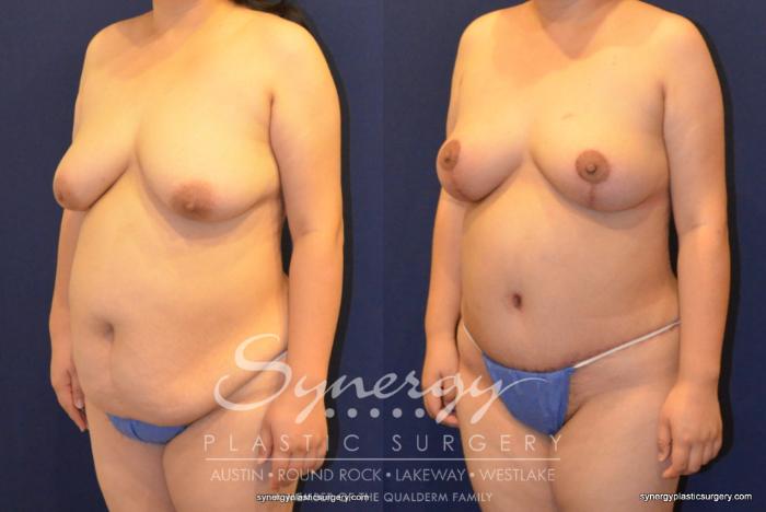 Before & After Mommy Makeover Case 395 View #5 View in Austin, TX