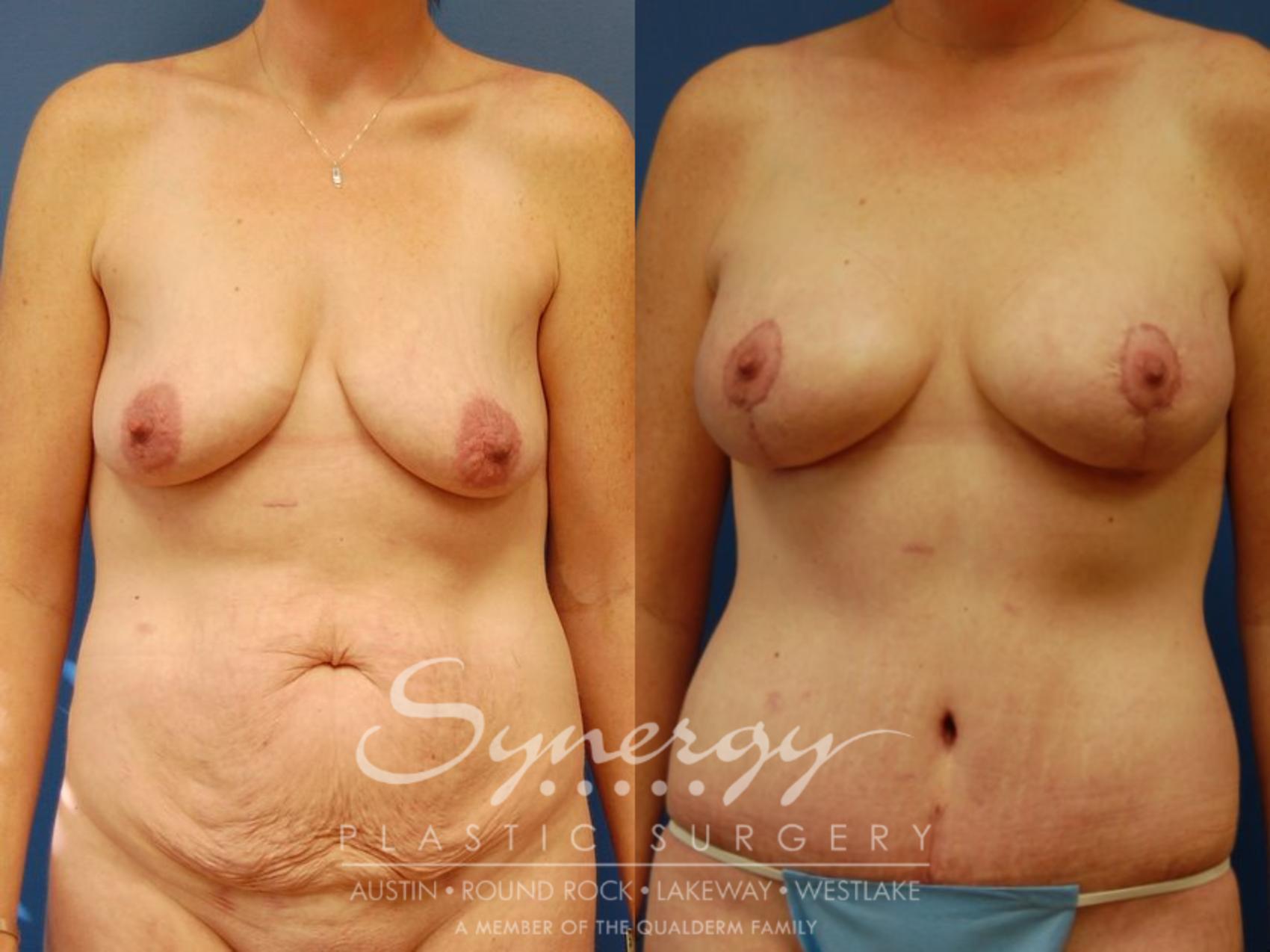 Before & After Mommy Makeover Case 40 View #1 View in Austin, TX