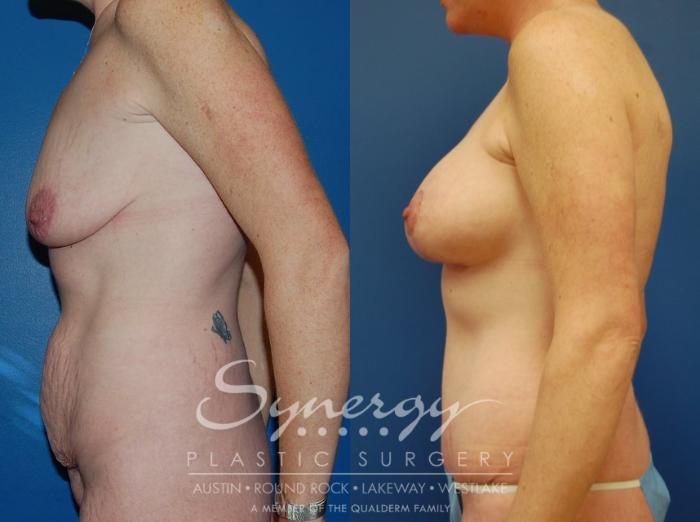 Before & After Mommy Makeover Case 40 View #2 View in Austin, TX