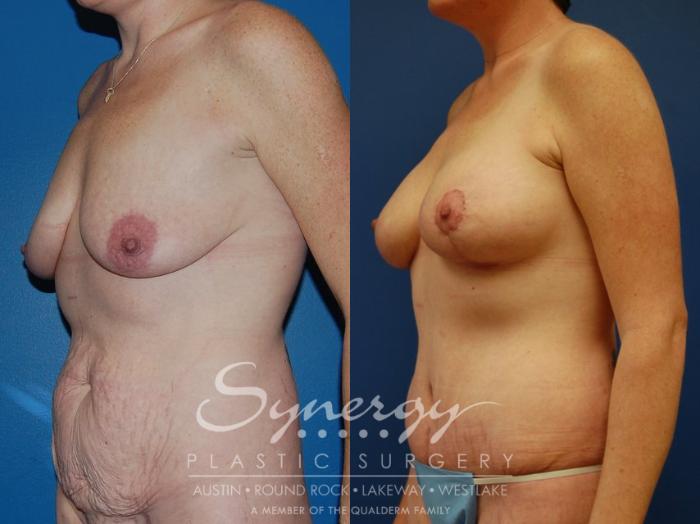 Before & After Mommy Makeover Case 40 View #3 View in Austin, TX