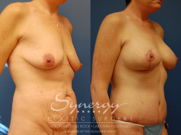 Before & After Mommy Makeover Case 40 View #4 View in Austin, TX