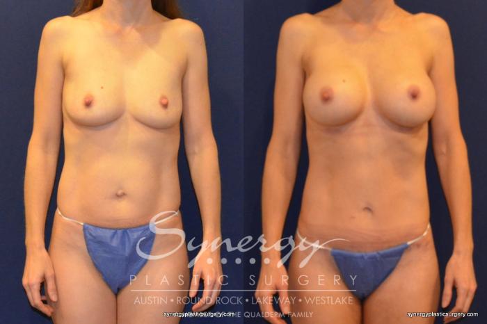 Before & After Mommy Makeover Case 400 View #1 View in Austin, TX