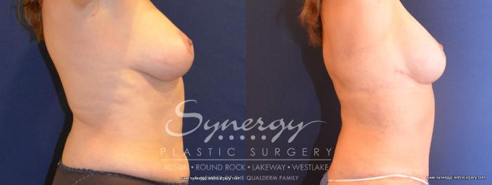 Before & After Mommy Makeover Case 420 View #2 View in Austin, TX