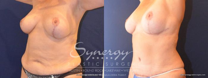 Before & After Mommy Makeover Case 420 View #4 View in Austin, TX