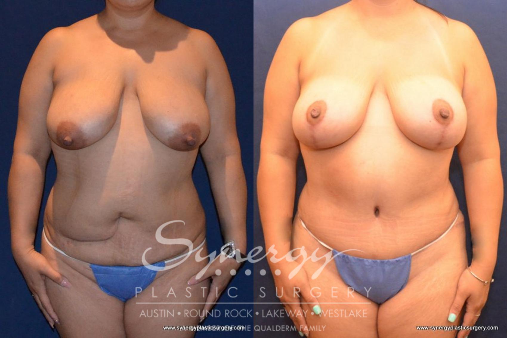 Before & After Mommy Makeover Case 430 View #2 View in Austin, TX