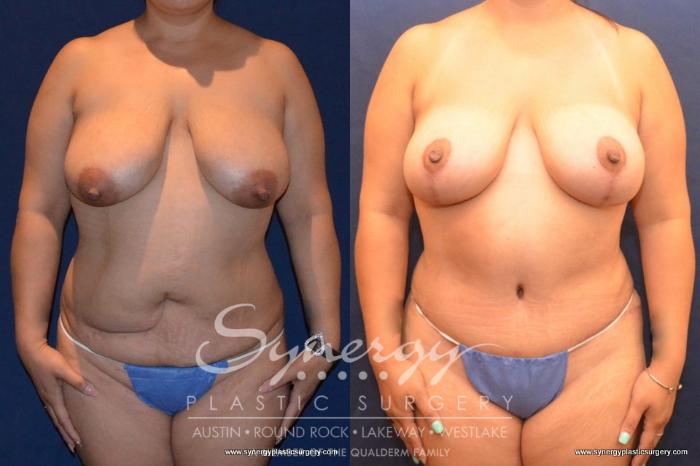 Before & After Mommy Makeover Case 430 View #2 View in Austin, TX