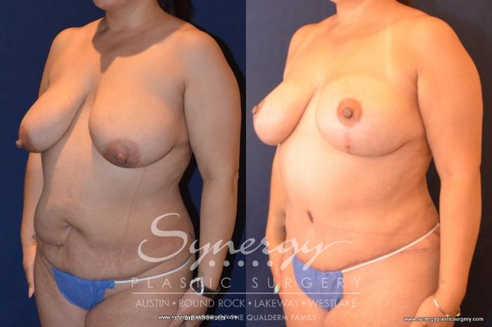 Before & After Mommy Makeover Case 430 View #4 View in Austin, TX