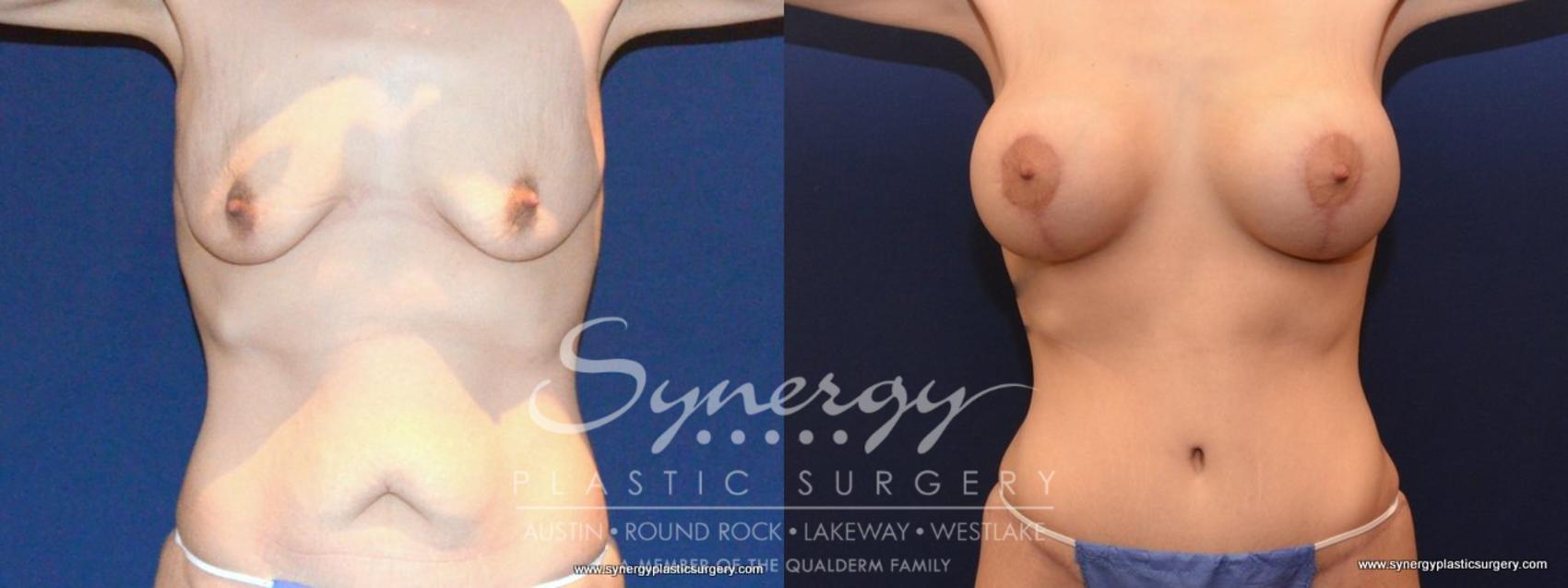 Before & After Mommy Makeover Case 456 View #1 View in Austin, TX