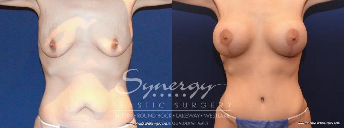 Before & After Mommy Makeover Case 456 View #1 View in Austin, TX