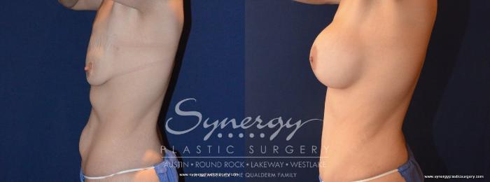 Before & After Mommy Makeover Case 456 View #2 View in Austin, TX