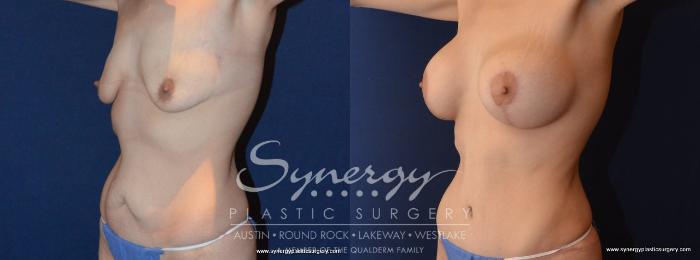 Before & After Mommy Makeover Case 456 View #3 View in Austin, TX