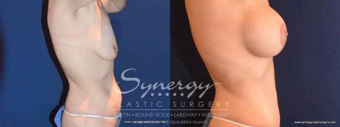 Before & After Mommy Makeover Case 456 View #4 View in Austin, TX