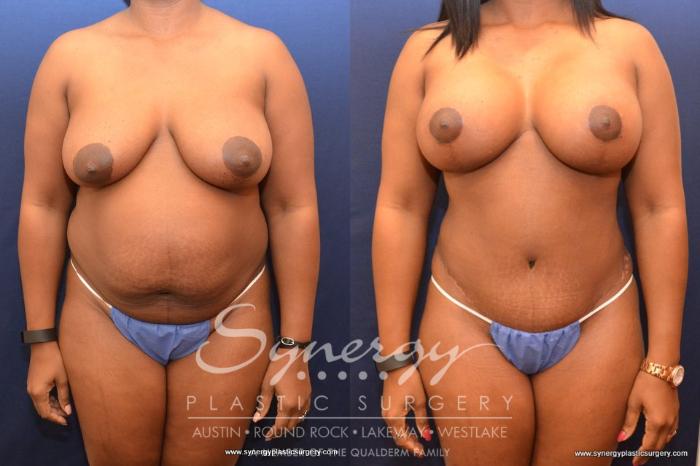 Before & After Mommy Makeover Case 509 View #1 View in Austin, TX