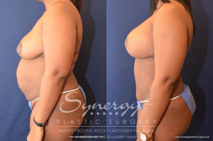 Before & After Mommy Makeover Case 509 View #3 View in Austin, TX