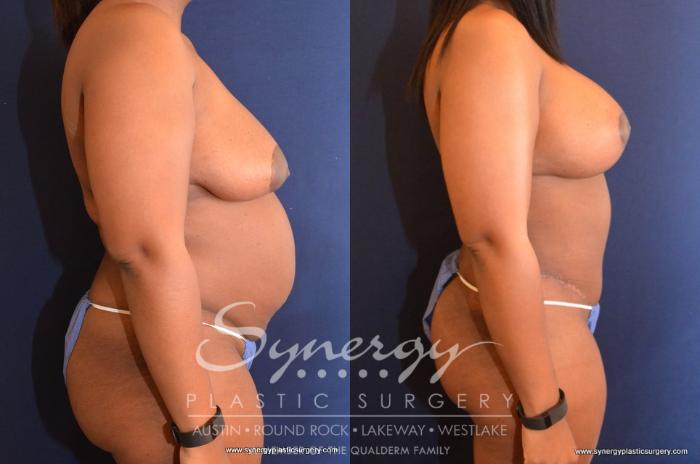 Before & After Mommy Makeover Case 509 View #4 View in Austin, TX