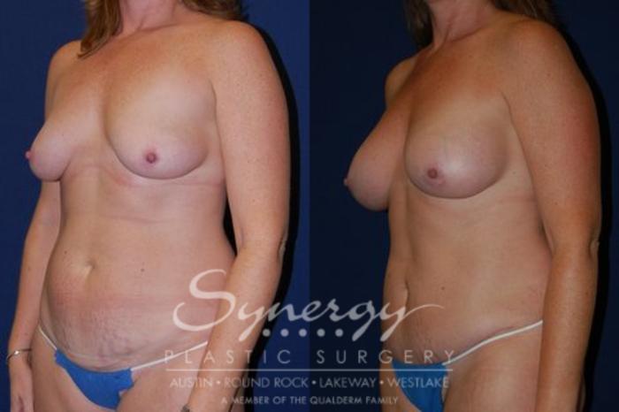 Before & After Mommy Makeover Case 54 View #1 View in Austin, TX