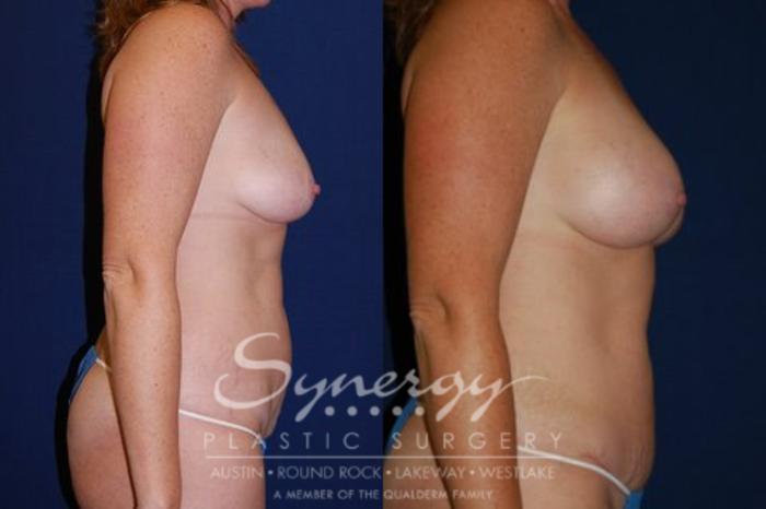 Before & After Mommy Makeover Case 54 View #2 View in Austin, TX