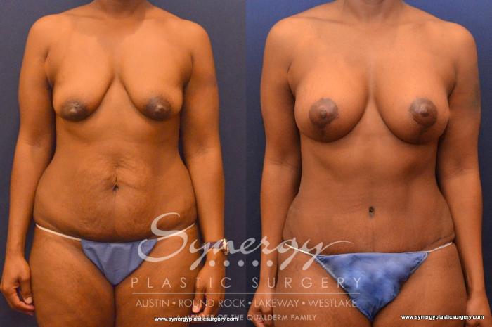 Before & After Mommy Makeover Case 555 View #1 View in Austin, TX