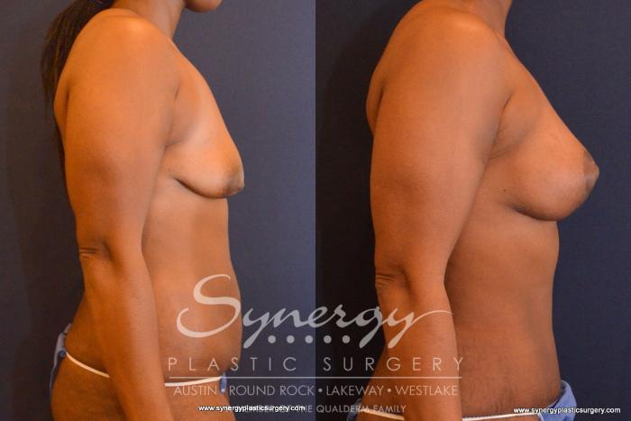 Before & After Mommy Makeover Case 555 View #2 View in Austin, TX