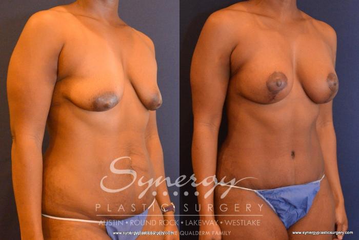 Before & After Mommy Makeover Case 555 View #3 View in Austin, TX