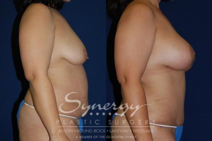 Before & After  Case 57 View #1 View in Austin, TX